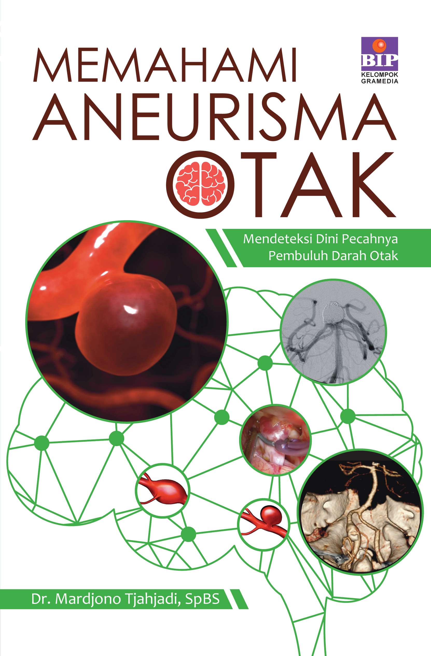 Memahami Aneurisma Otak